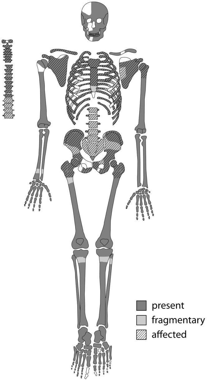 This anatomical diagram is a skeletal inventory and pathology map used in bioarchaeology and paleopathology to document the preservation and disease state of human remains (Skeleton Sk244-8). The graphic uses a standardized human skeletal template with a three-part coding system: dark gray indicates 'present' (full preservation), light gray indicates 'fragmentary' areas, and diagonal hatching denotes bones 'affected' by pathological changes. The map reveals that the axial skeleton—including the sternum, ribs, and most of the vertebral column—is heavily affected by lytic lesions. Both scapulae and the pelvic girdle (innominate bones and sacrum) also show significant involvement with hatching. The appendicular skeleton, specifically the long bones like the humeri, femora, and tibiae, is largely preserved but exhibits localized pathological involvement at the proximal joints. The skull shows a mix of full and fragmentary preservation. This visual summary is essential for illustrating the distribution of systemic skeletal diseases, such as metastatic carcinoma or multiple myeloma, in ancient populations.