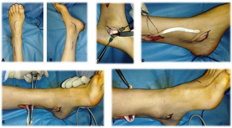 A series of clinical photographs (labeled A-F) documenting the surgical stages of a tibialis posterior tendon transfer for the correction of foot drop. Subfigures A and B show preoperative skin markings on the lower leg and dorsum of the foot, indicating the planned surgical approaches for tendon harvesting and insertion. Subfigure C demonstrates the identification and exposure of the tibialis posterior tendon through a medial incision using surgical retractors and forceps. Subfigure D illustrates the proximal delivery of the harvested tendon, showing its characteristic white, cord-like appearance as it is pulled through a proximal leg incision. Subfigures E and F depict the tunneling of the tendon through the interosseous membrane from the posterior compartment to the anterior compartment of the leg, utilizing surgical clamps and sutures for guidance. This procedure is common in orthopedics and rehabilitation medicine for restoring active dorsiflexion by repurposing the tibialis posterior muscle. The imagery demonstrates essential steps including marking, harvesting, and rerouting of the donor tendon.