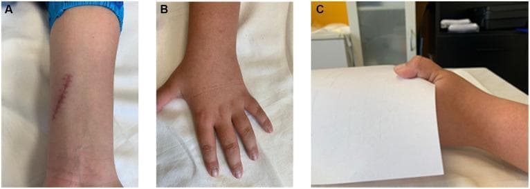 A composite of three clinical photographs (A, B, C) illustrating the presentation and functional deficits associated with a proximal ulnar nerve injury. Panel A shows a linear, slightly erythematous surgical scar on the volar aspect of the distal forearm, proximal to the wrist and Guyon's canal, consistent with a history of nerve repair. Panel B demonstrates the dorsal aspect of the hand with flattening of the transverse metacarpal arch and subtle wasting of the intrinsic muscles, often seen in ulnar nerve palsy. Panel C depicts a positive Froment's sign during a key pinch task with a piece of paper. This clinical sign is characterized by compensatory hyperflexion of the thumb's interphalangeal (IP) joint by the flexor pollicis longus (innervated by the median nerve) to overcome weakness of the adductor pollicis (innervated by the ulnar nerve). The series demonstrates the motor consequences of a 'claw hand' deformity and specific clinical provocative testing for ulnar nerve dysfunction.
