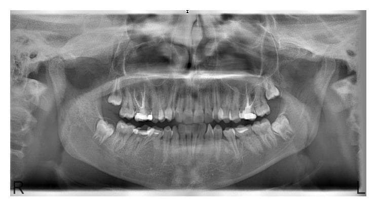 This diagnostic image is a panoramic radiograph (orthopantomogram) of the maxilla and mandible, illustrating radiographic signs characteristic of polyostotic craniofacial fibrous dysplasia. The image reveals multiple, ill-defined lesions with a classic 'ground-glass' appearance. Key affected anatomical regions include the right mandibular corpus and ramus, the mandibular symphysis, and the right posterior maxillary region. These lesions exhibit increased radiopacity and a hazy, homogeneous texture that obscures the normal trabecular bone pattern. The transition zones between the pathological lesions and the adjacent normal bone are indistinct, indicating a gradual, infiltrative process rather than a well-circumscribed border. In the right maxilla, there is evidence of slight bony expansion. The radiographic findings are essential for medical and dental students to identify the presentation of fibro-osseous lesions, emphasizing the diagnostic importance of bone texture changes (ground-glass vs. trabecular) and the loss of clear anatomical demarcation in craniofacial pathology.
