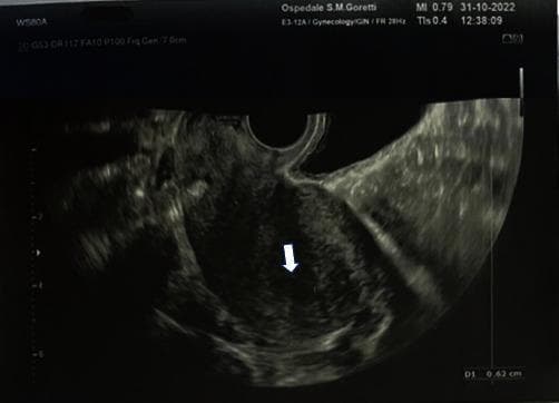 This diagnostic image is a transvaginal ultrasound (TVUS) of the uterus in a 36-year-old patient, performed as a post-procedural evaluation following dilatation and curettage (D&C) for a partial molar pregnancy. The uterus is visualized in a sagittal or longitudinal plane, appearing as a roughly pear-shaped or fan-shaped structure with mixed mottled echogenicity of the myometrium. A white arrow points to the endometrial cavity, which reveals a thin, regular, and linear hyperechoic (bright) endometrial stripe. This finding is clinically significant as it confirms the successful evacuation of gestational tissue and the absence of retained products of conception (RPOC). The image serves as an educational example of normal post-operative uterine morphology and the baseline appearance of the endometrium during the follow-up of gestational trophoblastic disease (GTD).
