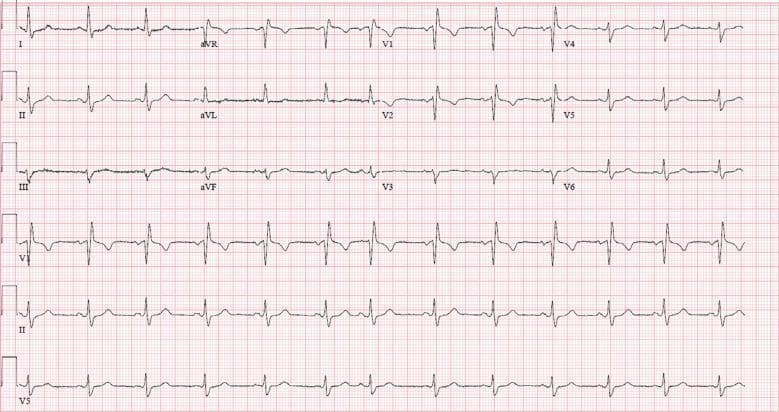 This diagnostic image is a standard 12-lead electrocardiogram (ECG) displayed on a red grid background, illustrating a regular sinus rhythm at approximately 76 beats per minute. The tracing demonstrates a consistent 1:1 P-wave to QRS complex relationship with normal P-wave morphology, confirming atrial and ventricular synchronization originating from the sinus node. Key findings include characteristics of an incomplete right bundle branch block (IRBBB). In precordial lead V1, a distinctive rsR' pattern is visible, characterized by an initial small positive 'r' wave, followed by a deeper 's' wave, and a secondary taller 'R'' wave. While the QRS duration is slightly widened compared to normal, it does not reach the full 120 ms threshold required for a complete bundle branch block. Additionally, slurred S waves are observed in the lateral leads (I, V5, V6), which are hallmark features of right-sided conduction delays. This ECG serves as an educational example of cardiac electrophysiology, specifically identifying minor intraventricular conduction disturbances within a normal sinus rhythm context.