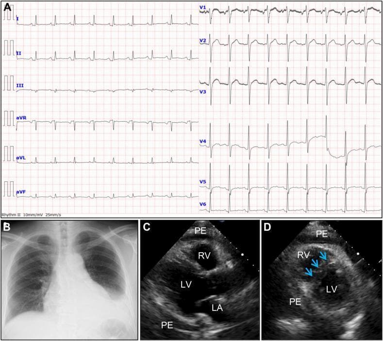 This composite figure illustrates the multimodal diagnostic findings of acute pericarditis with pericardial effusion. Panel A is a 12-lead electrocardiogram (ECG) demonstrating sinus tachycardia, generalized T-wave flattening, and PR-segment depression, with characteristic reciprocal PR-segment elevation in lead aVR. Panel B is a posterior-anterior chest radiograph showing a classic 'flask-shaped' or 'water-bottle' enlarged cardiac silhouette, indicative of large pericardial effusion, alongside a left-sided pleural effusion. Panels C and D are transthoracic echocardiogram frames. Image C (parasternal long-axis view) displays a significant circumferential pericardial effusion (PE) surrounding the right ventricle (RV), left ventricle (LV), and left atrium (LA). Image D (parasternal short-axis view at the mid-ventricular level) highlights the hemodynamic impact through abnormal diastolic septal motion (blue arrows), where the interventricular septum shifts toward the LV. These findings are consistent with constrictive physiology and transient constrictive pericarditis.