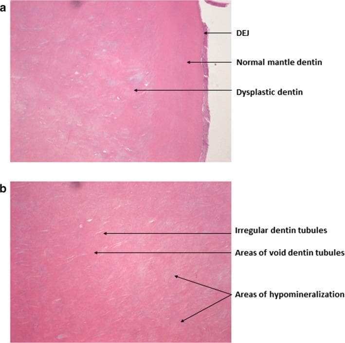 This composite of two light microscopy images (H&E stain) illustrates the histopathology of dentin in Dentinogenesis Imperfecta Type II (DI-II). Image (a) focuses on the dentino-enamel junction (DEJ), which exhibits an abnormally smooth, even appearance lacking typical scalloping. While the immediately adjacent mantle dentin appears relatively normal, the deeper layer consists of dysplastic dentin characterized by incomplete mineralization and pale-staining interglobular areas. Image (b) provides a high-magnification view of the circumpulpal dentin, demonstrating significant structural irregularities. Key features include enlarged and irregular dentin tubules with frequent branching, alongside areas where tubules are entirely void. Notable regions of hypomineralization are present throughout the dentin matrix. These findings characterize the hereditary dentin defect associated with DSPP gene mutations, explaining the clinically observed fragility and detachment of enamel from the underlying compromised dentin.