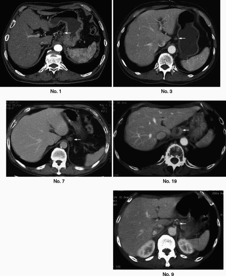 This composite diagnostic image features five axial CT scans of the upper abdomen, labeled No. 1, 3, 7, 19, and 9. The images demonstrate cross-sectional anatomy including the liver, spleen, stomach, kidneys, and vertebrae. The primary educational focus is on abdominal lymphadenopathy. In each panel, white arrows highlight soft-tissue density structures located in the retroperitoneum and perigastric regions. Specifically, the arrows indicate lymph nodes situated in the gastrohepatic ligament and the para-aortic area, adjacent to the abdominal aorta and the lesser curvature of the stomach. These nodes vary slightly in size and visibility across the different levels, appearing as rounded or ovoid masses. The images serve to teach the radiological identification of regional lymph nodes in the context of abdominal malignancies, such as esophageal or gastric cancer staging, emphasizing their spatial relationship to major vasculature and the diaphragmatic crura.