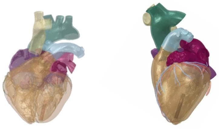 This anatomical diagram presents two views—frontal (left) and left lateral (right)—of the Dassault Systèmes Living Heart Human Model (LHHM), a high-fidelity 3D computational representation used for cardiovascular device evaluation. The model uses color-coded translucency to display internal and external structures: the left atrium is shown in purple, the aorta in light blue, and other major superior vessels in green and cream. Fine light-blue vessels representing coronary arteries are visible on the ventricular surface. A key educational feature is the placement of a leadless pacemaker, depicted as an elongated, dark-gray rectangular component. The device is strategically positioned in the apex region of the left ventricle. In the frontal view, the pacemaker is visible through the translucent ventricular wall, while the left lateral view clarifies its vertical orientation along the apical endocardium. This visualization demonstrates the spatial relationship between intracardiac medical devices and 3D cardiac anatomy in a simulated physiological environment.