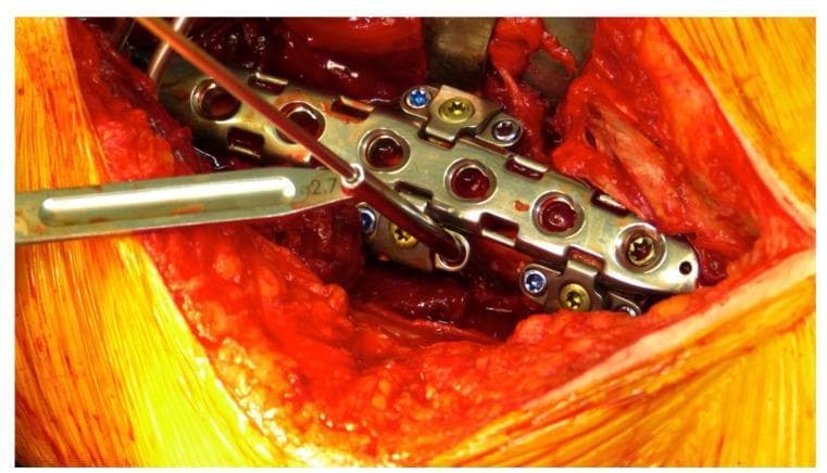 A close-up clinical photograph showing an intraoperative surgical field during orthopedic internal fixation for a periprosthetic fracture. The focal point is a metallic LOQTEQ® Variable Angle (VA) Periprosthetic Plate system secured to a bone. The central locking compression plate (LCP) features multiple circular screw holes. Adherent to the lateral margins of the main plate are specialized attachable hinges designed for variable-angle screw placement. These hinges contain inserted locking screws with color-coded blue and gold heads. A freehand drill guide with a 2.7 mm diameter marking is actively positioned within one of the hinge openings, demonstrating the technique for drilling a pilot hole at a specific angle to bypass existing intramedullary prosthetic hardware. The surgical site displays exposed muscle and soft tissue with moderate hemarthrosis/bleeding typical of open reduction and internal fixation (ORIF) procedures. This image illustrates the application of modular plating systems in complex fracture management where standard monocortical or biaxial screw trajectories are obstructed by an existing implant.