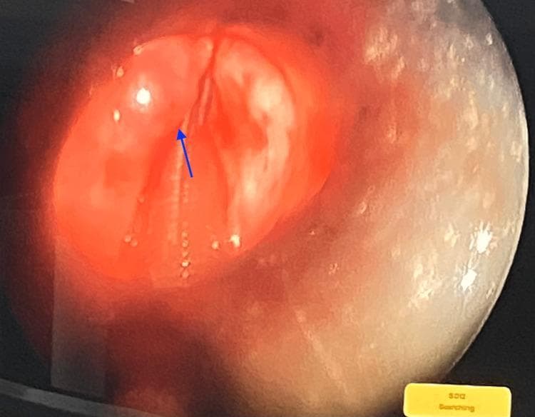 This clinical photograph displays a laryngeal view obtained via micro-laryngoscopy. The image provides an endoscopic perspective of the glottic opening, showing the true vocal cords (vocal folds) and the surrounding laryngeal mucosa. A blue arrow highlights a discrete, rounded mass located on the surface of the vocal cord. The mass appears well-circumscribed and pedunculated or bulging, characteristic of a benign-appearing laryngeal polyp or small nodule. The surrounding mucosa appears intact without obvious signs of severe acute inflammation or malignancy. The image demonstrates the surgical site for an endoscopic excision, a common procedure in otolaryngology for treating vocal cord lesions causing symptoms such as hoarseness (dysphonia). The lighting and magnification are consistent with micro-laryngoscopy, intended for detailed visualization and precise surgical intervention on the delicate structures of the larynx.