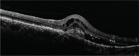 This diagnostic image is an Optical Coherence Tomography (OCT) cross-section of the human retina, demonstrating classic features of active choroidal neovascularization (CNV). The scan reveals a significant elevation of the neurosensory retina caused by subretinal fluid (SRF), appearing as a well-defined hyporeflective space between the photoreceptor layer and the underlying retinal pigment epithelium (RPE). Additionally, multiple hyporeflective intraretinal cystoid spaces are visible, indicating intraretinal fluid (IRF) or edema secondary to vascular leakage. There is an irregular, hyperreflective lesion at the level of the RPE-choriocapillaris complex, consistent with a neovascular membrane. These structural abnormalities disrupt the normal foveal contour and retinal lamination. The findings are characteristic of exudative maculopathy, often associated with conditions such as Presumed Ocular Histoplasmosis Syndrome (POHS) or neovascular age-related macular degeneration. This visual is an essential educational tool for identifying biomarkers of CNV activity and monitoring response to anti-VEGF therapy in ophthalmology.