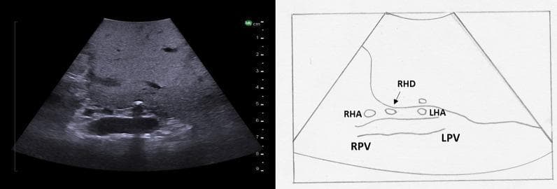 This diagnostic image consists of an intraoperative ultrasound of the liver (left) paired with an anatomical line diagram (right) illustrating the hepatic hilum in a transverse plane. The ultrasound displays normal liver parenchyma with medium echogenicity and a homogeneous texture. The central focus is the bifurcation of the portal vein and the overlying hepatic artery. Key anatomical structures labeled in the diagram and visible on ultrasound include the right portal vein (RPV) and left portal vein (LPV), which appear as larger, hypoechoic vascular structures. Positioned superficial to the portal bifurcation are the smaller, circular cross-sections of the right hepatic artery (RHA) and left hepatic artery (LHA). Additionally, the right hepatic duct (RHD) is identified as a small anechoic structure adjacent to the RHA. This visual material is used in surgical education to demonstrate the 'Mickey Mouse' sign and the spatial relationships within the hepatoduodenal ligament, essential for identifying segmental anatomy during hepatobiliary procedures.