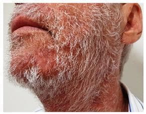 This clinical photograph displays the lower face and neck of an elderly male patient with a white beard, showcasing the resolution phase of tinea barbae. The skin in the perioral and submental regions exhibits mild residual erythema and post-inflammatory changes, but lacks the active, suppurative lesions typical of acute sycosiform tinea barbae, such as yellow papules, pustules, or nodular-cystic structures. The beard hair appears clean without significant crusting or matting, indicating a positive response to antifungal therapy (terbinafine). The anatomical focus is on the hair-bearing areas of the face and the upper neck. This image serves as an educational example of the clinical progression and healing of a deep fungal folliculitis after appropriate dermatological treatment, emphasizing the reduction in inflammatory infiltrate and the restoration of normal skin texture in the beard area.