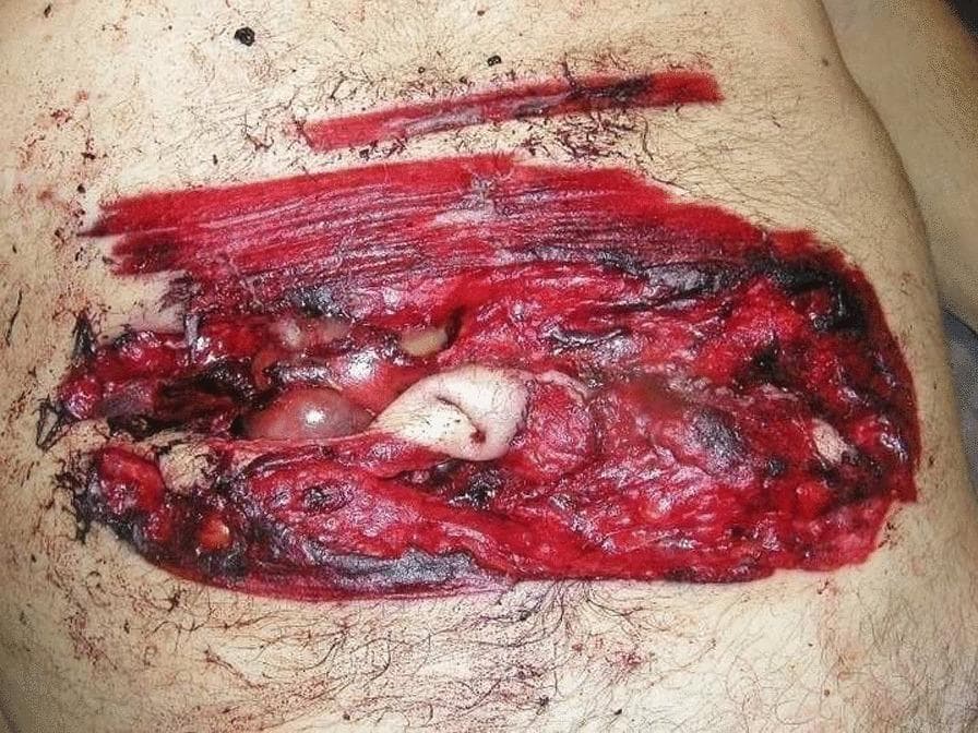 This clinical photograph from a forensic pathology context displays a large, complex abdominal wound. The primary lesion is a horizontal, deep incised wound located in the mesogastrium. The wound morphology is characterized by irregular, torn edges with focal areas of grazing, differing from a typical clean surgical incision. Centrally, the wound penetrates through the skin and subcutaneous fat layers, exposing internal structures including glistening, pinkish-white intestinal loops. Surrounding the deep defect is an extensive, well-demarcated area of reddish-brown abrasion and cutaneous bruising, measuring approximately 23 cm by 12 cm. There is evidence of peripheral blackish discoloration and hemorrhagic infiltration within the exposed tissue. Superior to the main lesion, a smaller, superficial linear 'trial' or hesitation wound is visible. The image illustrates severe abdominal trauma and is used in medical education to differentiate between standard incised wounds and those caused by high-velocity mechanical instruments like chainsaws.
