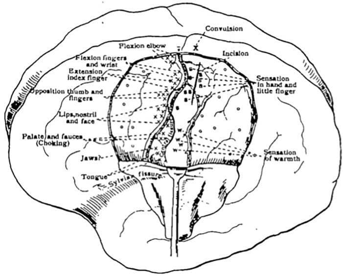 This historical anatomical diagram illustrates a cortical map of the human brain, specifically documenting findings from direct electrical stimulation (DES) during an early 20th-century awake craniotomy. The sketch depicts a lateral view of the cerebral cortex with a prominent Sylvian fissure and central sulcus area. The diagram functions as an early somatotopic map, distinguishing between motor and sensory localization. On the left (pre-central gyrus), motor responses are labeled, including flexion of the elbow, fingers, and wrist, extension of the index finger, and opposition of the thumb. Inferior regions map the lips, nostril, face, palate, jaws, and tongue. On the right (post-central gyrus), sensory responses are recorded, specifically noting sensations in the hand, little finger, and sensations of warmth. Annotations use symbols like 'X', 'B', and 'W' connected by dashed lines to indicate precise stimulation points on the cortical surface. Additional clinical markings include locations for 'Convulsion' and 'Incision'. This diagram is a foundational representation of functional neuroanatomy and the development of the motor and sensory homunculus in neurosurgery.