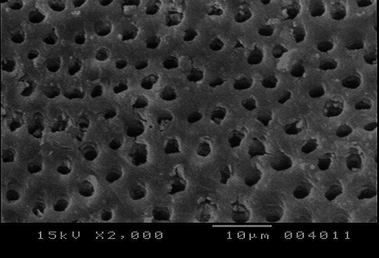 Scanning Electron Microscope (SEM) image at 2000x magnification showing the ultrastructure of human dentin. The diagnostic image displays a high density of dentinal tubules distributed across the calcified tissue surface. These tubules appear as roughly circular or elliptical dark openings against a lighter, textured intertubular dentin matrix. According to the 10 μm scale bar, the tubule diameters average approximately 1-2 μm. While many tubules demonstrate patent (open) lumens characteristic of a control or untreated sample, some exhibit partial occlusion by debris or mineral deposits. The image is used in dental research and endodontics to study dentin hypersensitivity, tubule occlusion treatments, and the structural integrity of tooth surfaces. The organization follows a relatively regular, porous pattern, serving as a baseline for comparing the efficacy of desensitizing agents or bonding materials in clinical dentistry.