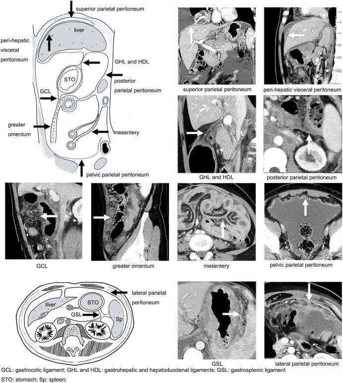 This composite educational resource consists of anatomical diagrams and corresponding computerized tomography (CT) scans illustrating the distribution and manifestation of peritoneal metastasis (PM). The anatomical diagrams (sagittal and axial views) label ten key peritoneal regions: superior, posterior, lateral, and pelvic parietal peritoneum; perihepatic visceral peritoneum; gastrohepatic and hepatoduodenal ligaments (GHL and HDL); gastrosplenic ligament (GSL); gastrocolic ligament (GCL); greater omentum; and the mesentery. The accompanying CT images demonstrate radiological signs of metastasis (indicated by white arrows) across these specific regions. Key diagnostic features highlighted include nodular thickening of the parietal peritoneum, increased soft tissue density in the GHL/HDL and GSL, and characteristic 'omental caking' within the greater omentum. Other findings show diffuse fibrosis strands and irregular thickening along the visceral peritoneum of the liver and mesentery. This content is designed for oncological imaging education, focusing on the systematic evaluation of tumor seeding within the abdominal cavity and the distinction between smooth normal linings and pathological nodularity.