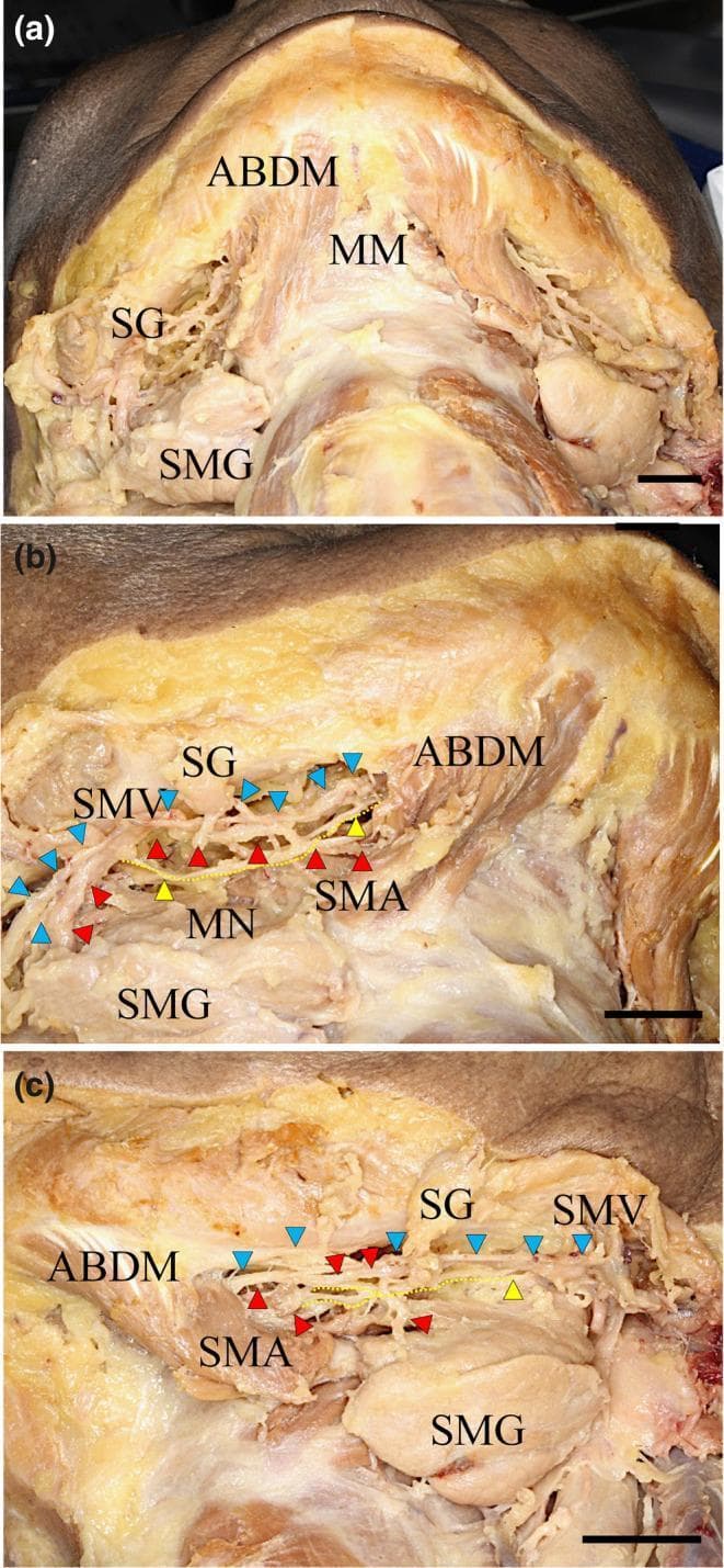 This composite of three clinical photographs (a-c) displays the gross anatomical dissection of the human submental region and mandibular floor. Figure (a) provides a wide superior view showing the mylohyoid muscle (MM), the anterior belly of the digastric muscle (ABDM), the submandibular gland (SMG), and the submandibular lymphatic ganglion (SG). Figures (b) and (c) offer higher magnification views of the right and left sides, respectively, detailing the neurovascular bundle situated between the MM and SMG. The submental nerve (MN), highlighted with yellow arrowheads and dotted lines, is seen coursing alongside the submental artery (SMA, red arrowheads) and the submental vein (SMV, blue arrowheads). These microscopic views emphasize the spatial relationship of the MN as it provides motor innervation to the mylohyoid muscle. The images illustrate the clinical anatomy relevant to submandibular surgery and local anesthesia, specifically identifying fine nerve branches that pierce the mylohyoid muscle to potentially communicate with the lingual nerve.