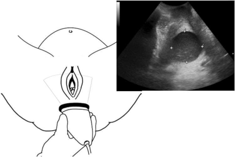 This composite educational graphic illustrates the technique and results of transperineal ultrasound for assessing cervical dilatation during labor. The left side features an anatomical diagram showing the positioning of a curvilinear ultrasound transducer at the perineum, oriented between the labia and the anus. The transducer is rotated to a transverse plane to capture the relevant internal structures. The right side displays a corresponding B-mode diagnostic ultrasound image. It shows a transverse view of the dilating cervix, characterized by a well-defined, circular hypoechoic region. Caliper markers (white plus signs) are visible on the ultrasound image, indicating the measurement of the cervical diameter in the anterior-posterior and transverse axes. The surrounding tissues exhibit varying echogenicities, representing anatomical landmarks such as the fetal head and pelvic floor structures. This material is designed for obstetrics education, demonstrating a non-invasive alternative to digital vaginal examinations for monitoring labor progression.