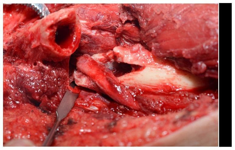 An intraoperative clinical photograph showing a surgical exploration of the mid-humerus via an anterolateral approach. The image demonstrates a humeral shaft fracture with a jagged, irregular fracture line. Centrally, the radial nerve is clearly visualized and is significantly interposed—or trapped—within the fracture site between the bone fragments. The nerve appears erythematous and swollen, consistent with a localized contusion or compression injury. Surrounding the fracture is exposed muscular tissue and a surgical retractor is visible at the left margin, highlighting the operative field. This visual provides high-level educational evidence of nerve entrapment as a potential complication of humeral fractures, demonstrating the anatomical relationship between the radial nerve and the humeral diaphysis.