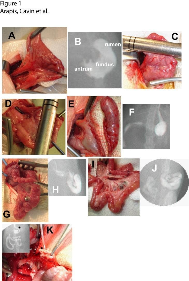 This composite figure illustrates the surgical steps and radiological outcomes of Vertical Sleeve Gastrectomy (VSG) and Roux-en-Y Gastric Bypass (RYGB) procedures using a rat model. (A-B) Baseline anatomy of the stomach, identifying the rumen (forestomach), fundus, and antrum via clinical photography and contrast radiography. (C-E) Intraoperative VSG steps demonstrating the use of a metallic staple gun for vertical resection of the rumen and fundus to reduce gastric volume. (F) Post-VSG radiography showing a tubularized gastric pouch. (G-J) RYGB procedure, including the creation of a small gastric pouch, gastro-jejunal anastomosis (G, H), and end-to-lateral jejuno-jejunal anastomosis (I, J) to form the alimentary limb, verified by contrast opacification. (K) Macroscopic necropsy view and radiographic insert (star) depicting a gastric fistula, a significant post-operative complication. The visual material details bariatric surgical techniques, gastrointestinal anastomotic structures, and radiographic verification of altered anatomy and complications such as leaks.