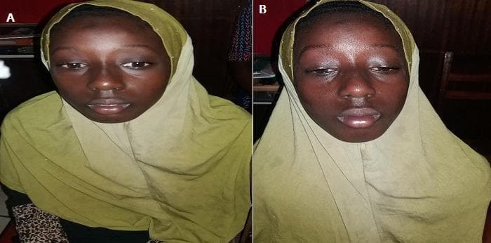 Two side-by-side clinical photographs (labeled A and B) documenting ocular symptoms in a pediatric patient. Image A demonstrates moderate bilateral ptosis, where the upper eyelids are abnormally low, partially obscuring the superior portion of the iris and pupil. Image B shows the same patient exhibiting significantly worsened or 'majorรฉ' bilateral ptosis, with the eyelids nearly fully occluding the pupils. This visual progression illustrates muscular fatigability, a classic clinical sign of juvenile ocular myasthenia gravis. The comparison demonstrates how sustained upward gaze or prolonged activity can exacerbate levator palpebrae superioris weakness. The images are categorized under ophthalmology and clinical neurology, serving as an educational resource for identifying ptosis severity and the diagnostic hallmark of fatigability in neuromuscular junction disorders.