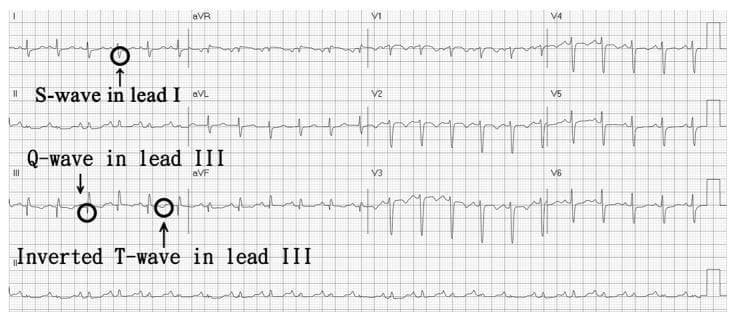 This diagnostic image is a 12-lead electrocardiogram (ECG) tracing demonstrating a classic S1Q3T3 pattern, a clinical sign of acute right heart strain often associated with pulmonary embolism. The ECG is annotated with black circles and arrows highlighting three primary visual features: a prominent S-wave in lead I (terminal negative deflection of the QRS), a pathological Q-wave in lead III (initial negative deflection), and an inverted T-wave in lead III. The tracing also shows sinus tachycardia, evidenced by a regular rhythm with a heart rate exceeding 100 beats per minute. The QRS complexes are generally narrow and upright in the precordial leads (V1-V6). This illustration is designed for medical students and clinicians to identify specific morphological ECG abnormalities that reflect the pathophysiological stress of the right ventricle against increased pulmonary vascular resistance.
