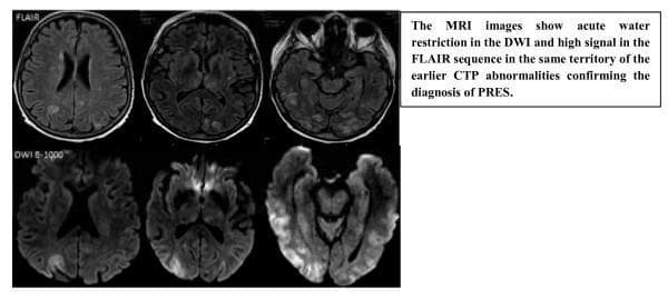 Diagnostic axial MRI brain scans demonstrating Posterior Reversible Encephalopathy Syndrome (PRES). The image set consists of two rows: Fluid-Attenuated Inversion Recovery (FLAIR) sequences on top and Diffusion-Weighted Imaging (DWI B-1000) sequences on the bottom. The FLAIR images show characteristic high signal intensity (hyperintensities) primarily located in the bilateral parietal and occipital lobes, indicating vasogenic edema. The corresponding DWI images demonstrate areas of altered signal in the same anatomical distribution, suggesting acute water restriction or cytotoxic edema within the posterior cerebral territories. The findings illustrate the classic neuroimaging features of PRES, often associated with malignant hypertension or cytotoxic medications. The distribution follows a predominantly posterior pattern, which is a hallmark for distinguishing this condition from typical arterial territory infarcts. These sequences are essential for evaluating the extent of cerebral involvement and distinguishing between reversible vasogenic edema and irreversible ischemic injury.