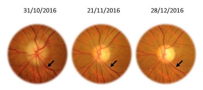 This Comparison Chart consists of three sequential color fundus photographs of the left eye, documenting the progression of ophthalmic findings over a two-month period (31/10/2016 to 28/12/2016). The images demonstrate the resolution of papilledema (optic disc edema) and venous congestion. In the initial photograph, the optic disc exhibits blurred margins, elevation, and obscuration of peripapillary vessels, characteristic of acute swelling. The retinal veins, highlighted by black arrows, appear significantly engorged and tortuous (venous turgescence). Subsequent images show a chronological improvement: the optic disc margins become progressively more distinct and sharp, indicating a reduction in edema. Simultaneously, the caliber of the retinal veins decreases, showing a marked reduction in turgidity and fullness. This timeline serves as a clinical illustration of treatment response or the natural history of intracranial pressure resolution. Key concepts include optic neuropathy, fundoscopy, venous caliber changes, and the morphological stages of papillary edema remission.