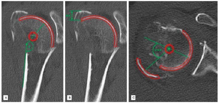 Diagnostic CT images of a right proximal humerus fracture (Neer type 4) demonstrating standardized radiological measurement techniques for fracture classification and fragment displacement. Panel A (coronal view) illustrates the head-shaft angle (HSA) measurement, utilizing a green line along the humeral shaft axis and a line intersecting the anatomical neck plane to assess for varus or non-varus alignment. Panel B (coronal view) displays the measurement of cranial displacement of the greater tuberosity in millimeters, indicated by vertical green markers. Panel C (axial view) shows the measurement of dorsal displacement of the greater tuberosity using an angular calculation. Across all panels, red outlines denote key anatomical fragments including the humeral head and greater tuberosity. These images provide a clinical methodology for evaluating orthopedic trauma, specifically relating to humeral head fractures and accompanying rotator cuff fragment position, which is critical for determining surgical intervention and prognostic outcomes in adult orthopedic medicine.