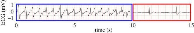 This diagnostic image displays a single-lead electrocardiogram (ECG) trace plotted over a 15-second period, demonstrating the effects of cardiopulmonary resuscitation (CPR) on signal morphology. The x-axis represents time in seconds (0-15s) and the y-axis represents voltage in millivolts (mV). The trace is divided into two distinct pedagogical segments: a 10-second blue-highlighted block (0-10s) and a 5-second red-highlighted block (10-15s). The blue segment shows a high-frequency, high-amplitude waveform with significant mechanical artifacts and baseline instability characteristic of active chest compressions during CPR. These artifacts mask the underlying rhythm, showing oscillations between -1 mV and 1 mV. In contrast, the red segment (10-15s) illustrates a 'CPR pause' for pulse assessment. This section shows a much cleaner signal with a stable baseline and lower frequency, revealing distinct, organized QRS complexes. The image serves as a comparison chart for medical education, teaching the visual identification of CPR-related artifacts versus spontaneous cardiac rhythms and the necessity of pauses for accurate rhythm interpretation.