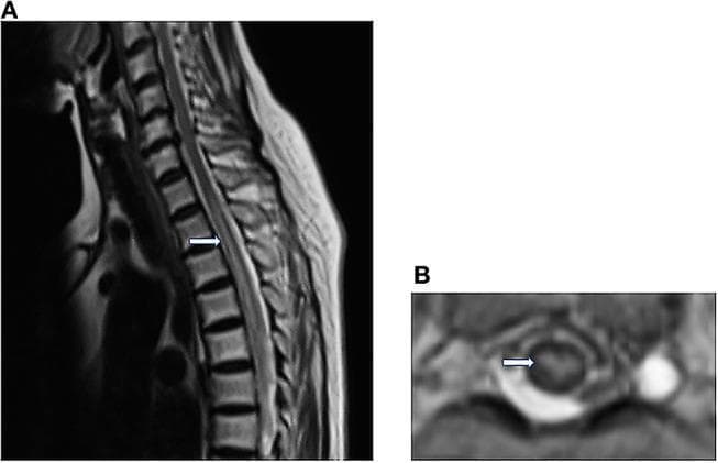 Magnetic resonance imaging (MRI) of the thoracic spine demonstrating features of anterior spinal cord syndrome. Panel A shows a sagittal T2-weighted image (T2WI) with a prominent, longitudinally extensive linear hyperintensity within the spinal cord, extending from approximately T2 to T10. Panel B displays an axial T2WI at the T8 vertebral level, highlighting bilateral, symmetrical hyperintense spots localized to the anterior horns of the gray matter. This classic radiological finding is known as the 'owl’s eye appearance' or 'snake-eye appearance,' which is highly characteristic of spinal cord infarction, particularly in the distribution of the anterior spinal artery. The imaging captures the typical central gray matter vulnerability to ischemia or embolic events, such as air embolism, in the context of vascular compromise.