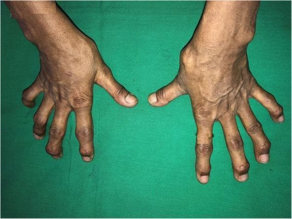 Clinical photograph showing the dorsal view of both hands against a green background, demonstrating advanced articular deformities. The image highlights significant bony enlargement at the distal interphalangeal (DIP) and proximal interphalangeal (PIP) joints, consistent with Heberden's and Bouchard's nodes typical of severe nodal osteoarthritis. There is visible malalignment and deviation of multiple digits, giving the fingers a gnarled appearance. A prominent bony swelling is also noted on the dorsal aspect of the right wrist. The overlying skin appears thin, dry, and wrinkled with prominent creases over the joints, but notably lacks the taut, shiny appearance characteristic of sclerodactyly. The medical context suggests these musculoskeletal changes are comorbid with a systemic condition like scleredema, although the hand deformities themselves are primarily osteoarthritic in nature. This image serves as an educational tool for distinguishing chronic degenerative joint disease from the skin tightening seen in systemic sclerosis.