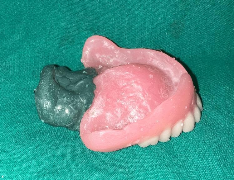 Clinical photograph of a maxillary complete denture being used for a functional impression of a velopharyngeal defect. The image shows a pink acrylic denture base with artificial white teeth set into the flange. Attached to the posterior aspect of the denture is a dark gray, high-viscosity impression compound. This material has been molded to capture the morphology and dimensions of a velopharyngeal defect, facilitating the fabrication of a speech bulb obturator. The impression material exhibits a matte, irregular, and functionally contoured surface, contrasting with the smooth, polished texture of the pink denture base. The prosthesis is resting on a green surgical drape. This visual demonstrates a critical step in maxillofacial prosthodontics for rehabilitating patients with hypernasal speech and palatal insufficiency, showing the spatial relationship between the dental arch support and the posterior extension required for velopharyngeal closure.