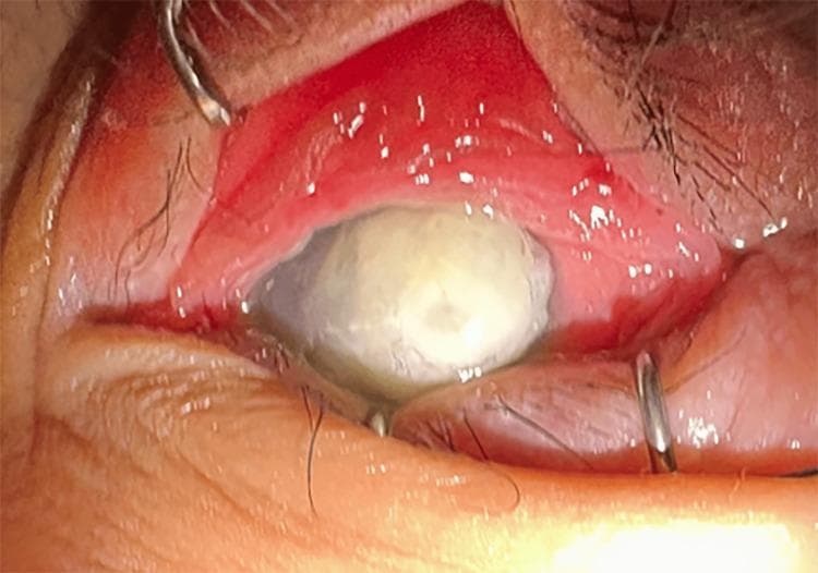 This clinical photograph shows a close-up view of the left eye (LE) demonstrating severe keratomalacia, a condition characterized by corneal melting often secondary to severe vitamin A deficiency. The cornea is completely opaque with a dense, whitish, necrotic appearance (leukomalacia) that obscures any view of the underlying iris or pupil. A visible perforation is present, indicating a full-thickness defect in the corneal stroma. The surrounding bulbar and palpebral conjunctiva exhibit significant hyperemia (redness) and inflammation. The eyelids are being held open by surgical retractors to facilitate examination. This visual serves as a critical educational example of advanced xerophthalmia, emphasizing the end-stage ocular manifestations of nutritional deficiency and the potential for irreversible ocular surface destruction.