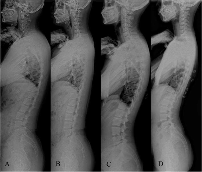 This diagnostic image consists of four standing lateral full-spine radiographs (A-D) illustrating the Roussouly classification of sagittal spinal alignment. Each panel demonstrates varying degrees of thoracic kyphosis, lumbar lordosis (LL), and sacral slope (SS). Panel A (Type I) shows a low sacral slope (<35°), a long thoracic kyphosis, and a short, minimal lumbar lordosis arc. Panel B (Type II) displays a low sacral slope and a relatively flat, elongated lumbar profile. Panel C (Type III) represents a 'harmonious' spine with a moderate sacral slope (35°-45°) and well-balanced curves. Panel D (Type IV) features a high sacral slope (>45°) associated with a pronounced, hyperlordotic lumbar curve and a shorter thoracic kyphosis. These radiographic types are used in orthopedic surgery and physiatry to evaluate spino-pelvic parameters, postural variations, and degenerative patterns in the sagittal plane. Key visible landmarks include the cervical, thoracic, and lumbar vertebrae, as well as the sacrum and pelvis, used to measure pelvic incidence, pelvic tilt, and the sagittal vertical axis.