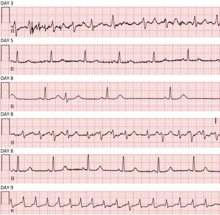A series of sequential electrocardiogram (ECG) rhythm strips showing Lead II tracings over a seven-day clinical course, illustrating fluctuating cardiac rhythms and conduction disturbances. Day 3 displays a rapid, irregularly irregular rhythm with absent P-waves and undulating fibrillatory baseline, diagnostic of atrial fibrillation with rapid ventricular response (RVR). Day 5 shows spontaneous conversion to sinus rhythm with identifiable P-waves and a more regular rate. Tracings from Day 8 highlight significant rhythm instability, including a slow escape rhythm with widened, unusual QRS morphologies and ST-segment deviations, followed by a transition back to a tachycardic, irregular wide-complex rhythm. Day 9 demonstrates a return to a more regular sinus rhythm with distinct P-waves preceding each QRS complex. This timeline serves as a clinical illustration of paroxysmal atrial fibrillation, conversion pauses, and the management of rhythm and rate control in a symptomatic patient.