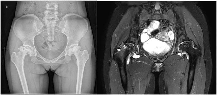 This dual-modality comparison presents an anteroposterior (AP) radiograph and a coronal MRI T2-weighted short tau inversion recovery (STIR) sequence of the pelvis in a 35-year-old patient with systemic lupus erythematosus (SLE). The visual illustrates advanced femoral head osteonecrosis (FHON). On the left (radiograph), bilateral femoral head abnormalities are visible, more severe on the patient's right side, characterized by significant flattening, subchondral sclerosis, and loss of the normal spherical articular contour. On the right (MRI), the STIR sequence highlights extensive bone marrow edema and cystic changes within both femoral heads. High signal intensity (bright areas) indicates fluid accumulation and active inflammatory processes, while heterogeneous low-signal areas correspond to bone death and collapse. The images demonstrate a comparison between the sensitivity of plain films for detecting structural bone changes versus the MRI's ability to visualize intramedullary pathology and joint effusion. This serves as an educational example of secondary osteonecrosis associated with systemic autoimmune disease and corticosteroid therapy.