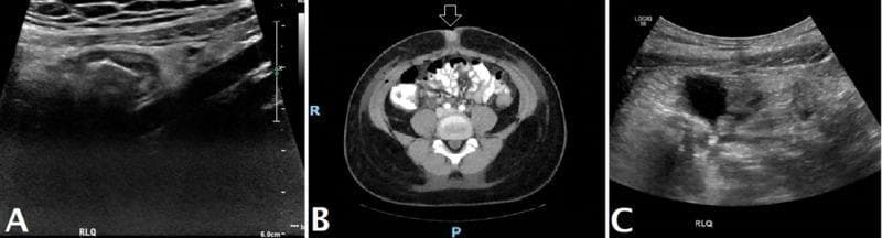 This composite figure displays diagnostic imaging of the abdomen across three panels, illustrating the progression from acute appendicitis to postsurgical status. Panel A shows an ultrasound of the right lower quadrant (RLQ) featuring a blind-ending, non-compressible, tubular structure with a 'target' appearance in the transverse plane, measuring approximately 9 mm in diameter, indicative of acute appendicitis. Panel B is an axial CT scan of the pelvis with intravenous contrast following an appendectomy and terminal ileum resection. It demonstrates postsurgical changes in the right anterior abdominal wall, mild subcutaneous emphysema (air), and high-density, non-enhancing fluid collections in the cul-de-sac and prevesical space, suggesting a phlegmon or postsurgical fluid. Panel C presents a follow-up postsurgical ultrasound of the RLQ, highlighting localized free fluid and hyperechoic inflammatory changes in the mesenteric fat. These images collectively provide a clinical educational overview of radiological features associated with complicated appendicitis and typical postoperative radiological findings.