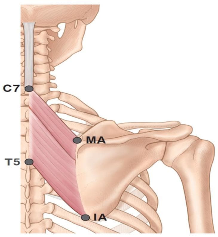 This anatomical diagram illustrates the superficial and deep musculature of the posterior thoracic region, specifically focusing on the left rhomboid muscles. The illustration depicts the skeletal framework including the cervical and thoracic spine, the scapula, and the proximal humerus. Four key anatomical landmarks are identified with markers: the spinous process of the seventh cervical vertebra (C7), the spinous process of the fifth thoracic vertebra (T5), the medial angle (MA) of the scapula, and the inferior angle (IA) of the scapula. The rhomboid muscles are shown with their characteristic oblique fiber orientation, originating from the midline nuchal ligament and spinous processes (ranging from C7 to T5) and inserting along the medial border of the scapula. This diagram serves as a clinical reference for understanding musculoskeletal anatomy, surface landmarks for physical examination, and the localization of intramuscular targets for therapeutic interventions such as botulinum toxin injections or electromyography.