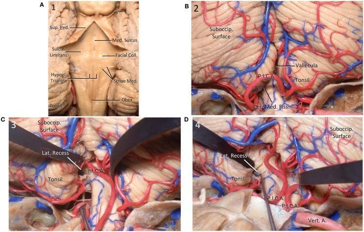 This anatomical illustration consists of four cadaveric dissection photographs (A-D) detailing the neuroanatomy of the posterior fossa, specifically the fourth ventricle and cerebellum. Figure A shows the posterior floor of the fourth ventricle (rhomboid fossa), highlighting the median sulcus, superior peduncle, facial colliculus, hypoglossal triangle, striae medullares, and the obex. Figure B depicts the posterior cerebellum, illustrating the suboccipital surface, cerebellar tonsils, and the course of the posterior inferior cerebellar artery (PICA) within the cerebellomedullary fissure. Figures C and D demonstrate a surgical approach via tonsillar retraction. In Figure C, the left tonsil is retracted superolaterally to expose the medulla and the lateral recess of the fourth ventricle. Figure D shows a dissector placed within the lateral recess, highlighting its spatial relationship to the PICA and the vertebral artery. These images serve as educational resources for neurosurgical planning and posterior fossa anatomy, emphasizing critical vascular and neural landmarks required for safe microsurgical navigation.