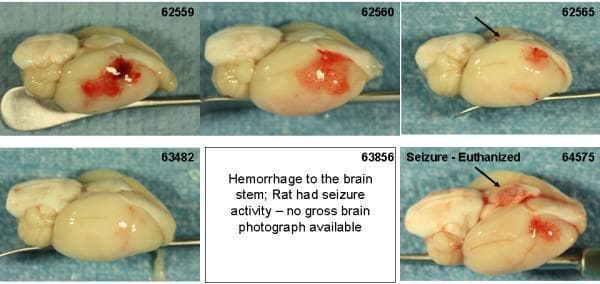 This clinical photograph displays a series of gross pathological specimens from a rat brain model used to study cerebrovascular disease and thrombolytic-induced complications. The set illustrates varying degrees of intracerebral and subarachnoid hemorrhage following middle cerebral artery occlusion (MCAo). Individual specimens (labeled 62559, 62560, 62565, 63482, and 64575) demonstrate a spectrum of superficial bleeding severity. Notable findings include large, confluent areas of cortical hemorrhage (62559, 62560), more localized petechial bleeding (62565, 64575), and a specimen with a relatively clean infarct showing minimal hemorrhage (63482). Black arrows specifically highlight regions of interest such as brain stem or posterior fossa involvement in specimen 64575, which is contextually associated with clinical seizure activity. This comparative layout is used in medical research to evaluate the safety profile and bleeding complications (hemorrhagic transformation) of thrombolytic agents like rt-PA and plasmin variants in the context of ischemic stroke treatment.