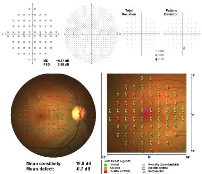 This diagnostic composite compares visual field testing modalities for ophthalmology. The top row illustrates data from a Humphrey Field Analyzer (HFA) using a 10-2 pattern and SITA Standard strategy. It includes a numeric sensitivity grid (decibels), a grayscale plot, and 'Total Deviation' and 'Pattern Deviation' probability maps for detecting localized scotomas. Global indices such as Mean Deviation (MD) and Pattern Standard Deviation (PSD) are provided. The bottom row displays MP-1 microperimetry results, featuring a fundus photograph with an overlaid 10-2 testing grid. The fundus image shows the optic disc, macula, and retinal vasculature. The magnified view on the right categorizes individual test points by color: green for normal sensitivity, yellow for suspect, and red for relative scotoma, with a legend for local defect classifications. This comparison demonstrates the integration of functional perimetry data with structural retinal anatomy, useful for diagnosing and monitoring macular diseases and glaucoma.
