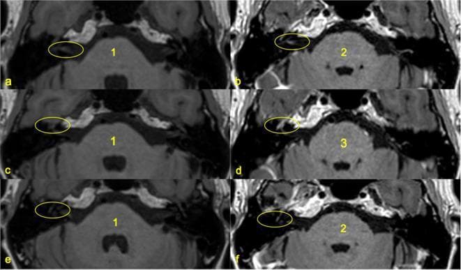 This diagnostic imaging set consists of six 3D T1-weighted Fast Spin Echo (FSE) MRI axial slices at the level of the pons and internal auditory canals. The panels demonstrate a qualitative Likert scoring system (0–3) for gadolinium contrast enhancement of various facial nerve (CN VII) segments. Panels a, c, and e represent pre-contrast images where the facial nerve segments (circled in yellow) show a baseline signal intensity equivalent to the brainstem (Score 1). Panels b, d, and f represent post-gadolinium sequences showing different grades of pathological enhancement. Panels a and b compare the fundal canalicular segment, showing an increase to Score 2 (signal intensity between brainstem and subcutaneous fat). Panels c and d compare the geniculate ganglion, showing a marked increase to Score 3 (signal intensity equal to subcutaneous fat). Panels e and f compare the tympanic segment, showing an increase to Score 2. This comparison is clinically significant for evaluating inflammatory or neoplastic conditions of the facial nerve, such as Bell's palsy or Ramsay Hunt syndrome, by quantifying blood-nerve barrier breakdown.
