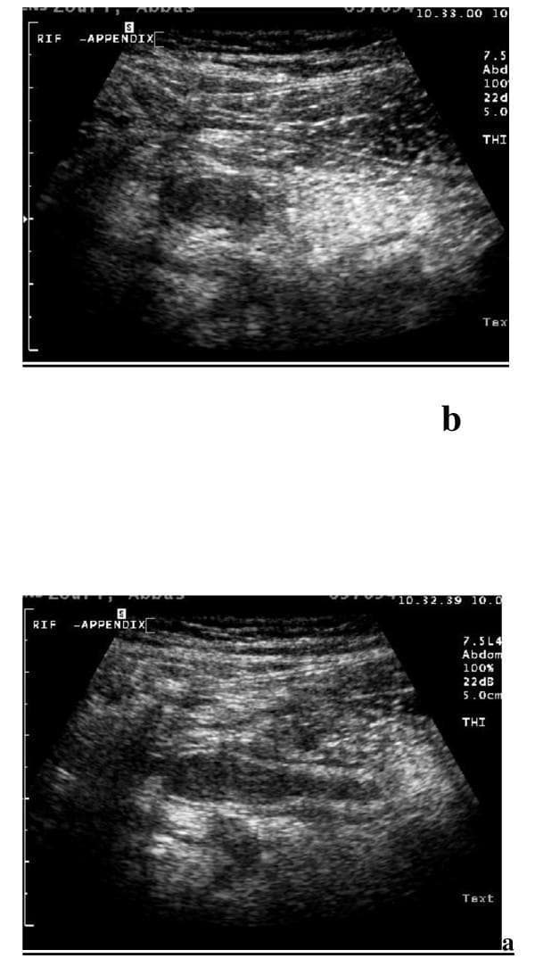 This diagnostic image displays Tissue Harmonic Imaging (THI) sonography of the right iliac fossa (RIF) demonstrating signs of acute appendicitis. The content is divided into two views: (a) a longitudinal scan and (b) a transverse scan, both acquired using a high-frequency (7.5 MHz) linear transducer. In the longitudinal view (a), the appendix appears as a blind-ended, aperistaltic, and non-compressible tubular structure with a significantly thickened wall and a total diameter exceeding 6 mm. In the transverse view (b), the inflamed appendix exhibits the characteristic 'target sign' or 'bull's-eye' appearance, consisting of concentric layers with alternating echogenicity, which corresponds to the histological layers of the appendiceal wall. These findings are hallmarks of appendiceal inflammation. The high-resolution THI technology enhances the visualization of these tissue interfaces compared to conventional ultrasound, aiding in definitive diagnosis for medical students and clinicians.
