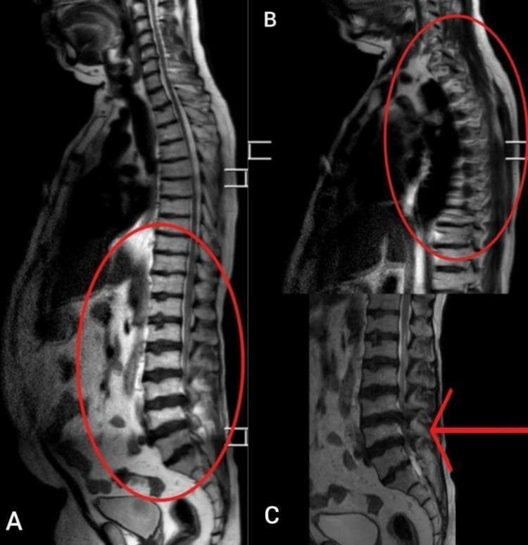 Diagnostic sagittal Magnetic Resonance Imaging (MRI) of the spine, presented in three views (A, B, and C) highlighting degenerative and structural pathologies. Panel A shows a lateral view of the lumbar and sacral spine, demonstrating significant kyphosis and loss of normal lumbar lordosis. Red ovals in panels A and B delineate regions of multi-level vertebral body wedging, irregular endplates, and prominent osteophyte formation characteristic of Scheuermann disease. Panel C provides a focused view of the lower lumbar region where a red arrow points to significant spinal canal stenosis. Visible features include reduced intervertebral disc height, disc bulging, and ligamentous hypertrophy contributing to the narrowing of the neural canal. The imaging captures extensive degenerative disc disease across multiple vertebral levels, demonstrating the clinical progression of juvenile osteochondrosis into adult spinal deformity.