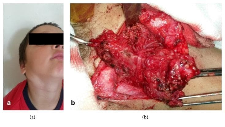 This composite educational material consists of a clinical photograph (a) and an intraoperative photograph (b) documenting a parotid gland tumor, identified as a plexiform neurofibroma. Panel A shows a pediatric patient with significant facial asymmetry due to a longitudinal swelling in the right parotid and submandibular region. The mass is approximately 3 cm in diameter, causing outward displacement of the mandibular angle. Panel B displays the surgical exploration during a superficial parotidectomy. The image shows a large, hemorrhagic, and multinodular mass with a gelatinous appearance. Surgical instruments are seen retracting tissues to expose the tumor's intimate relationship with the facial nerve trunk. The intraoperative view demonstrates displacement of the facial nerve's temporofacial and cervicofacial branches due to chronic compression. Key educational concepts include the clinical presentation of parotid masses, surgical anatomy of the facial nerve, and the characteristic 'bag of worms' appearance of plexiform neurofibromas in the cervicofacial region.