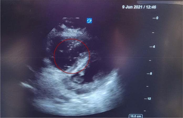 This diagnostic image is a Point-of-Care Ultrasound (POCUS) showing a cardiac view in a patient with suspected amniotic fluid embolism (AFE). The primary finding is the presence of multiple discrete, hyperechoic particles visualized within the right-sided heart chambers (right ventricle/atrium). Within the red-circled area of interest, these particles exhibit a non-uniform distribution, varying in size from fine, punctate echoes to larger, irregularly shaped fragments. The presence of these hyperechoic 'speckles' against the normally anechoic (black) blood pool is a key ultrasonographic sign suggesting the physical entry of particulate matter—such as fetal squamous cells, lanugo, or vernix—into the maternal venous circulation. The image also suggests right ventricular dilatation, consistent with acute right heart strain and pressure overload typically seen in massive embolic events. This visual material is critical for emergency medicine, obstetrics, and cardiology education, illustrating the rapid diagnostic utility of echocardiography in identifying life-threatening peripartum complications.