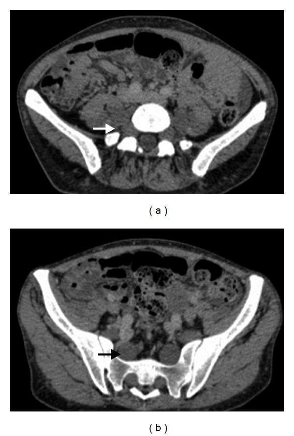 Two axial CT images of the pelvic and lower lumbar region in a 34-year-old patient demonstrate classic manifestations of Neurofibromatosis Type 1 (NF1). The images show bilateral, multi-segmental plexiform neurofibromas involving the lumbar and sacral nerve roots. These neurofibromas appear as irregular, ill-defined masses of soft tissue density that follow the course of the lumbosacral plexus. Key findings include marked enlargement and thickening of the nerve roots as they exit the neural foramina, with subsequent infiltration and displacement of adjacent soft tissues. Arrows highlight specific areas of nerve root expansion and the loss of normal perineural fat planes. The bony anatomy of the sacrum and iliac wings is visible, providing anatomical landmarks for the location of these peripheral nervous system tumors. The presentation is highly characteristic of the 'bag of worms' morphology associated with plexiform neurofibromas in the setting of NF1.