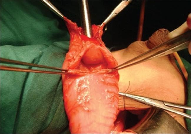 This clinical photograph captures an intraoperative view of a posterior sagittal anorectoplasty (PSARP) for the correction of an anorectal malformation. The image demonstrates a surgically opened, dilated rectal pouch being held apart by multiple surgical forceps. Within the lumen of the reddish-pink rectal tissue, a rare anatomical finding known as a rectal diaphragm is visible. The diaphragm appears as a raised, circular, obstructive shelf of tissue located approximately 2 cm proximal to the distal end of the pouch. A surgical metal probe or sound is positioned within the lumen to highlight the anatomical relationship between the distal blind pouch and the proximal obstruction. The visual evidence illustrates a complex variant of anorectal atresia where internal septation complicates the identification of the proximal bowel lumen during corrective surgery. This photograph is intended for pediatric surgery education, specifically regarding the identification of atypical internal obstructions in neonates and children with anorectal malformations.