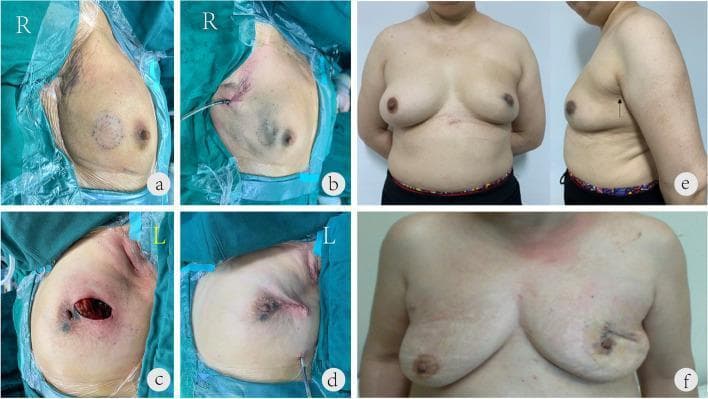 This set of clinical photographs compares the aesthetic outcomes and incision sites of single-port insufflation endoscopic breast-conserving surgery (SIE-BCS) versus conventional breast-conserving surgery (C-BCS). Panels (a, b) show intraoperative SIE-BCS with a single 2.5 cm incision placed within the axillary skin folds, alongside the use of methylene blue for sentinel lymph node and tumor margin identification. Panels (c, d) depict the C-BCS technique, which utilizes two separate incisions: one in the axillary fossa and another directly overlying the breast tumor site. Panels (e, f) provide 12-month postoperative follow-up comparisons. Panel (e) demonstrates a superior aesthetic result following SIE-BCS, with no visible scarring on the breast surface and a well-concealed, faint scar in the axilla (indicated by a black arrow). In contrast, panel (f) shows the outcome of conventional lumpectomy and sentinel lymph node biopsy, characterized by two distinct, visible scars on the breast surface. The images highlight the clinical benefit of single-port endoscopic techniques in minimizing visible scarring and preserving breast aesthetics in cancer treatment.