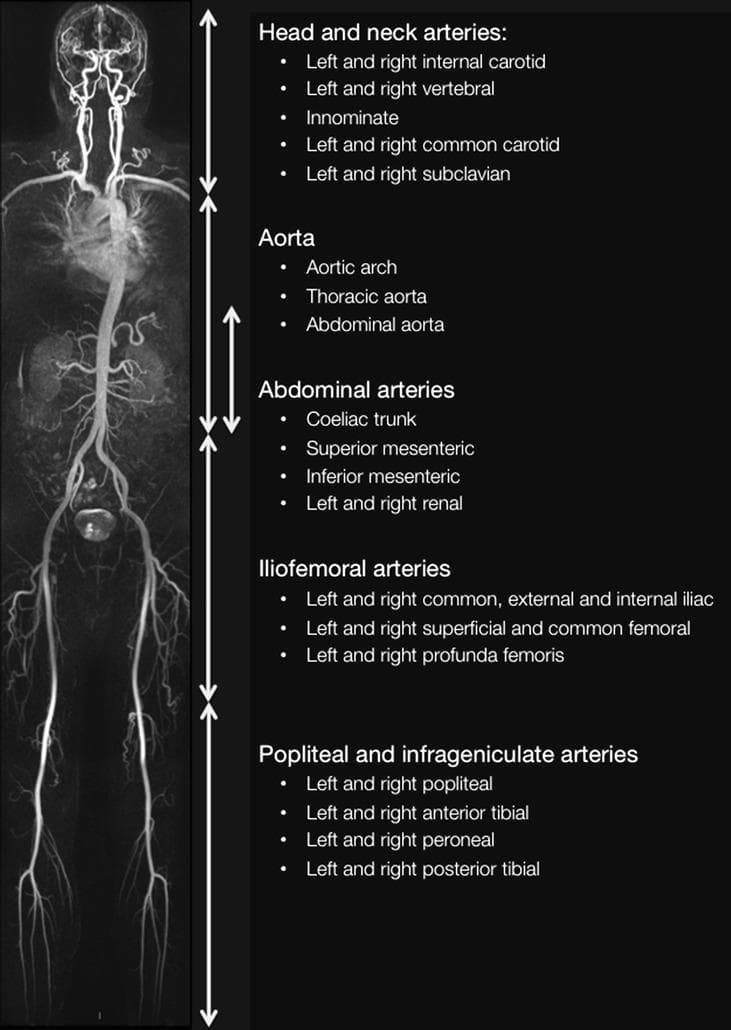 A whole-body diagnostic image presented as a Maximum Intensity Projection (MIP) of a Magnetic Resonance Angiogram (MRA). The visual provides a comprehensive coronal overview of the human arterial system from the cranium to the lower extremities, accompanied by descriptive labels of vascular territories. The content is divided into five anatomical stations: (1) Head and neck arteries, including carotids, vertebrals, and subclavians; (2) Aorta, encompassing the arch, thoracic, and abdominal segments; (3) Abdominal arteries, detailing the celiac trunk, superior/inferior mesenteric, and renal arteries; (4) Iliofemoral arteries, showing the common/external/internal iliac and femoral systems; and (5) Popliteal and infrageniculate arteries, highlighting the trifurcation into anterior/posterior tibial and peroneal vessels. The image serves as an educational reference for whole-body vascular anatomy and systematic assessment of arterial patency, atherosclerosis, or stenotic lesions. The visualization highlights the continuous, tapering morphology of the arterial tree and its major branch points, essential for radiology trainees and vascular specialists.